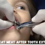 When Can I Eat Meat after Tooth Extraction